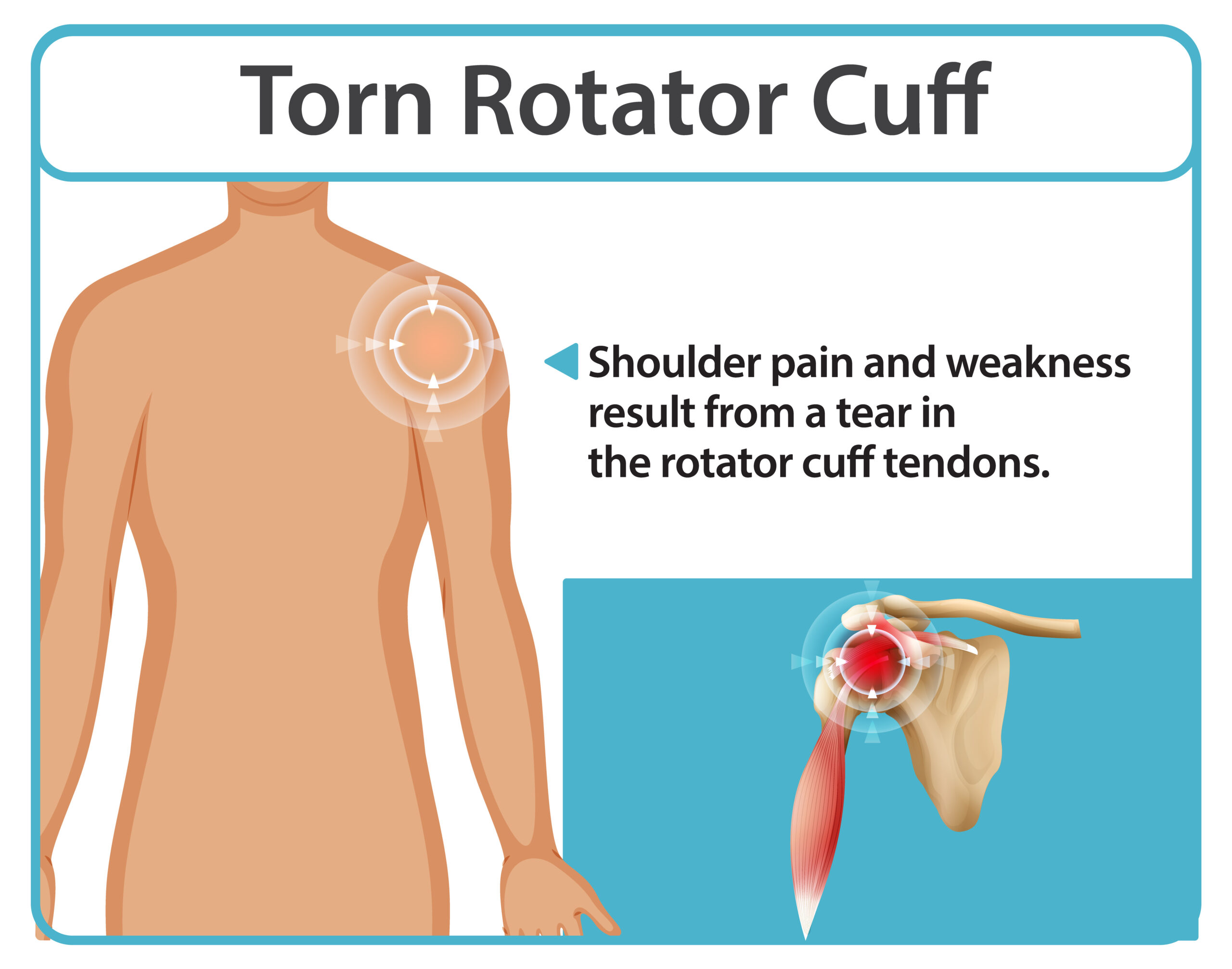 Torn Rotator Cuff Muscles