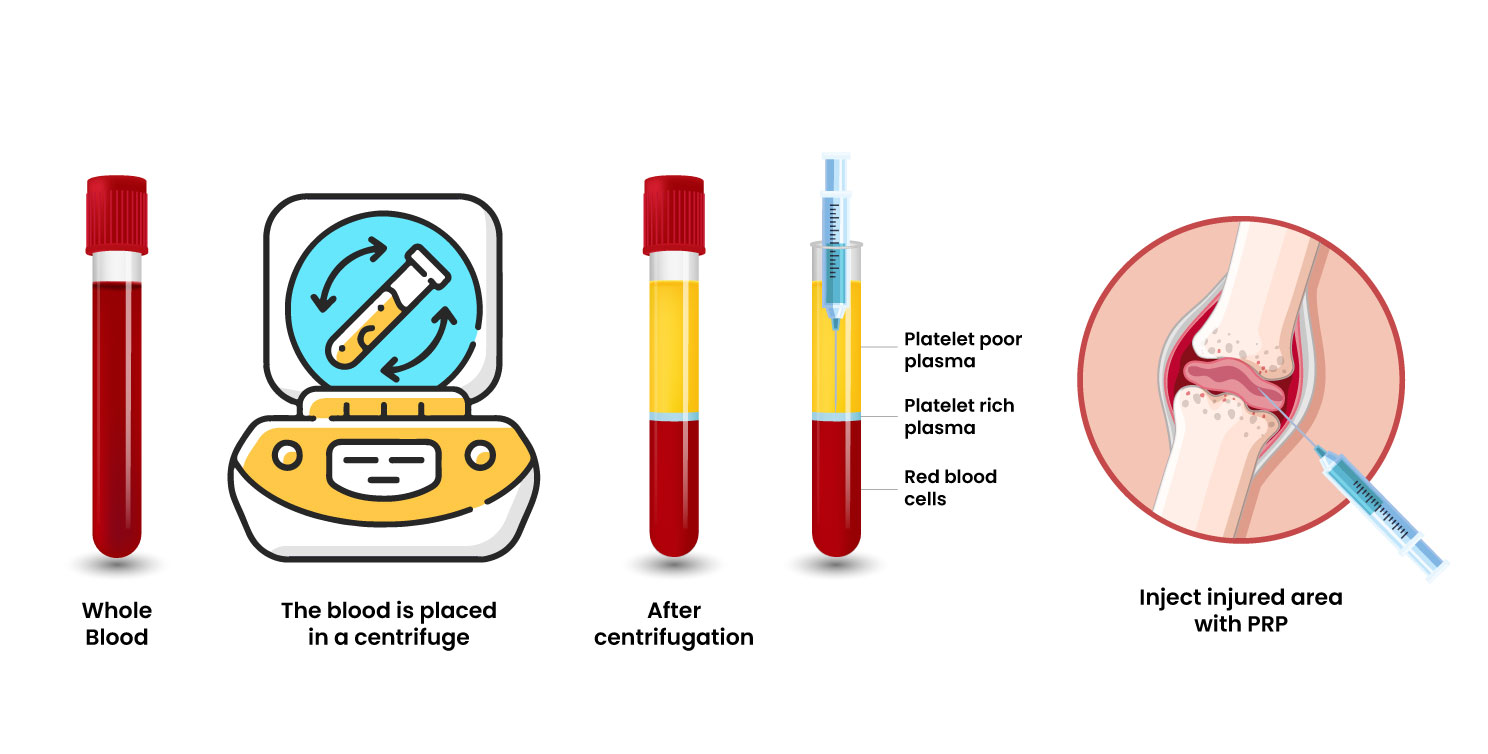 PRP Therapy Knee Procedure