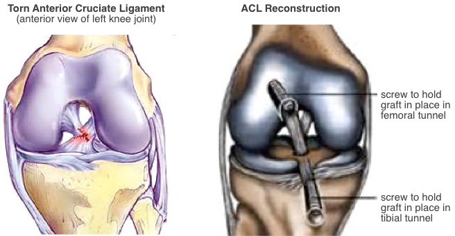 ACL Injury Treatment