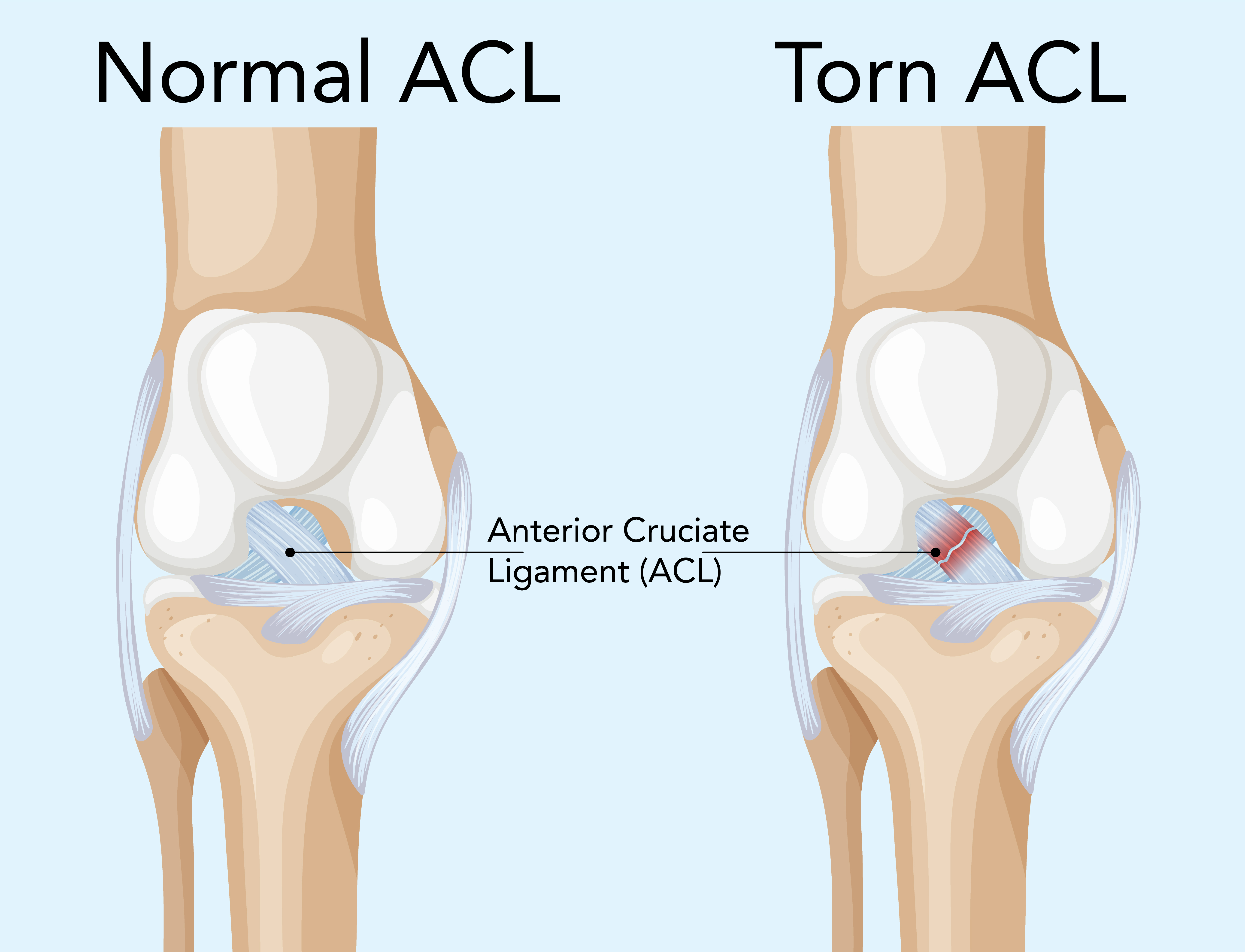 ACL Tears