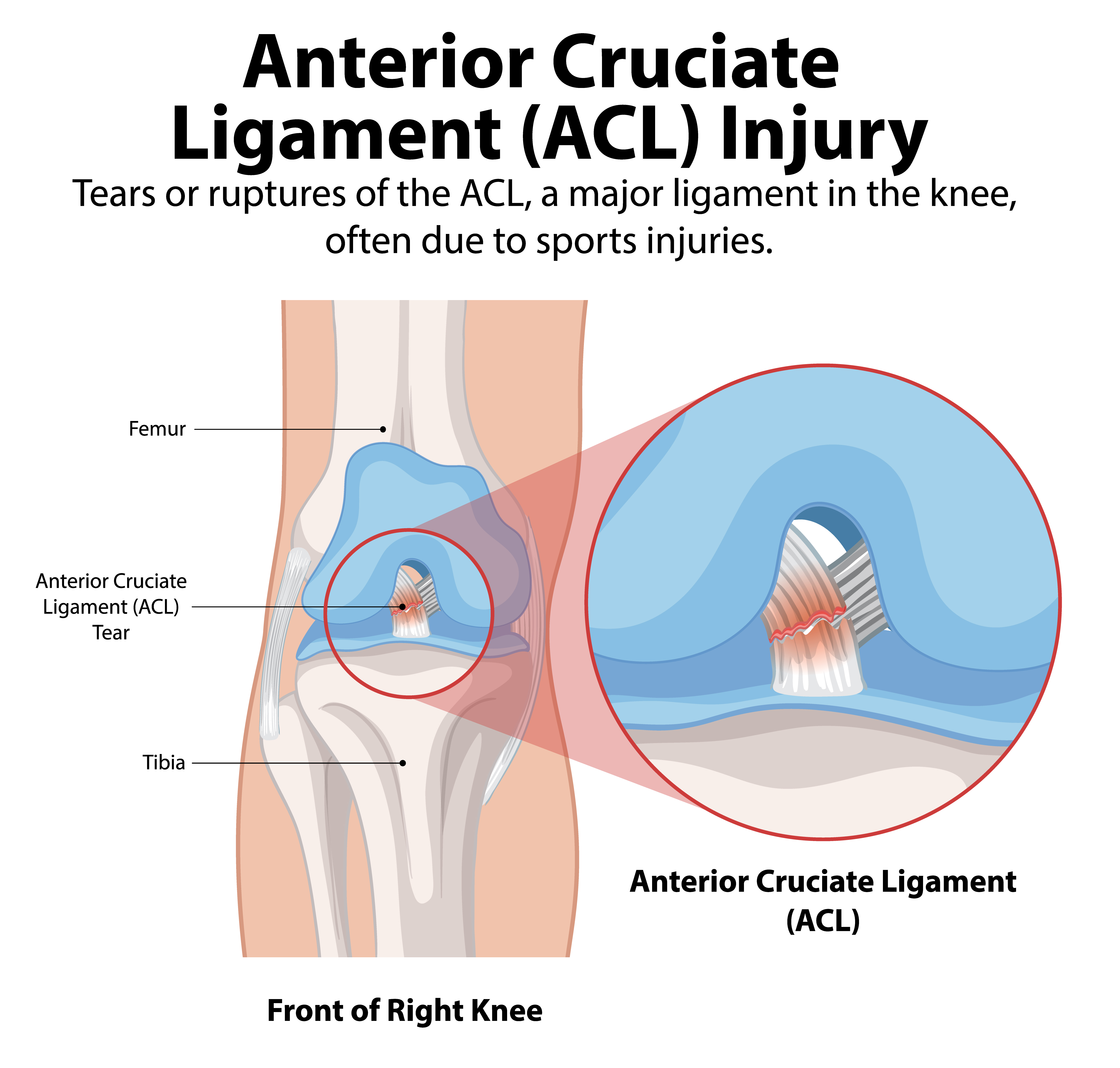 Anterior Cruciate Ligament ACL Injury Symptoms Treatment Options 